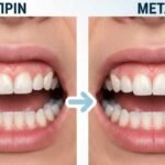 περιοδοντιτιδα πριν και μετα